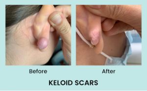 Keloid Scars before & after