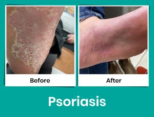 psoriasis- before- after