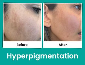 Hyperpigmentation- before- after