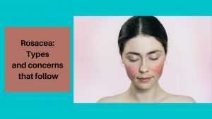 Rosacea treatment in Vancouver BC