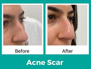 Acne scar- before- after