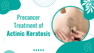 Precancer Treatment of Actinic Keratosis- blog banner image