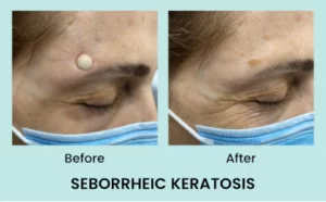 Seborrheic-Keratosis-treatment