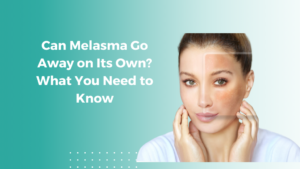 Can Melasma Go Away on Its Own? What You Need to Know