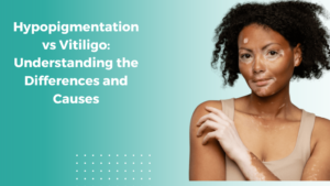 Hypopigmentation vs Vitiligo