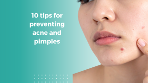10 tips for preventing acne and pimples