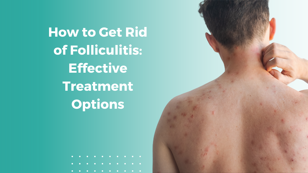 How to Get Rid of Folliculitis: Effective Treatment Options
