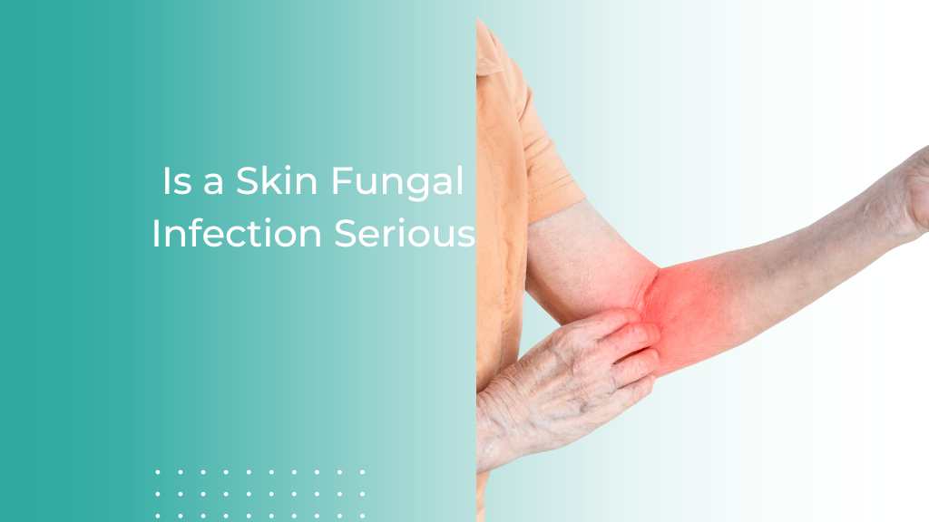 Is a Skin Fungal Infection Serious